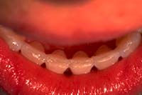 A Ribbond post-orthodontic retainer is a popular alternative to a metal arch wire retainer.